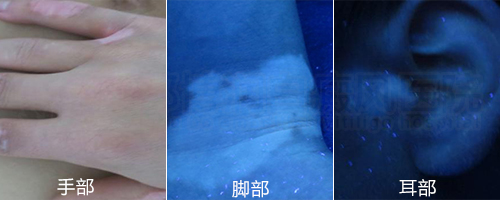 阳光总在风雨后,因为坚持白斑终康复
