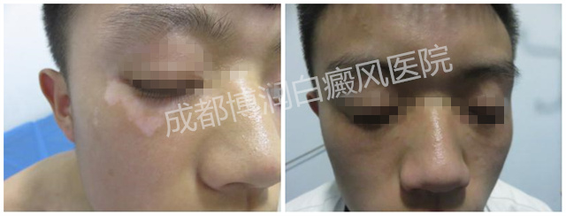 被常识所害,打破白斑枷锁获科学治疗