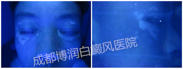 被常识所害,打破白斑枷锁获科学治疗